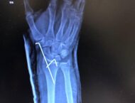 Andrea Dovizioso se destroza la muñeca practicando motocross 8 Andrea Dovizioso lesion mano (4)