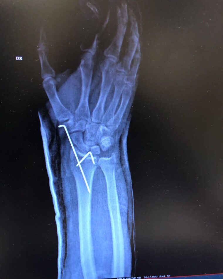 Andrea-Dovizioso-lesion-mano (4)