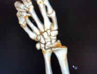 Andrea Dovizioso se destroza la muñeca practicando motocross 7 Andrea Dovizioso lesion mano (6)