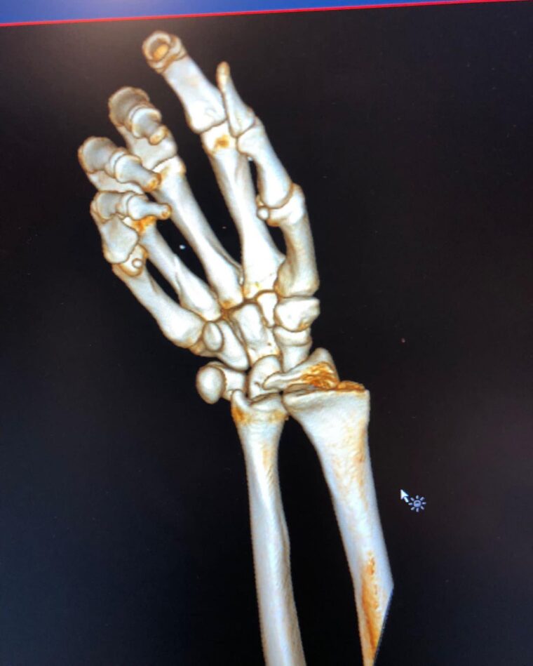 Andrea-Dovizioso-lesion-mano (6)