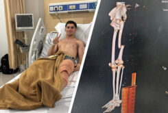 David Muñoz, operado de una fractura con desplazamiento del fémur 5 david munoz fractura femur moto3 indonesia